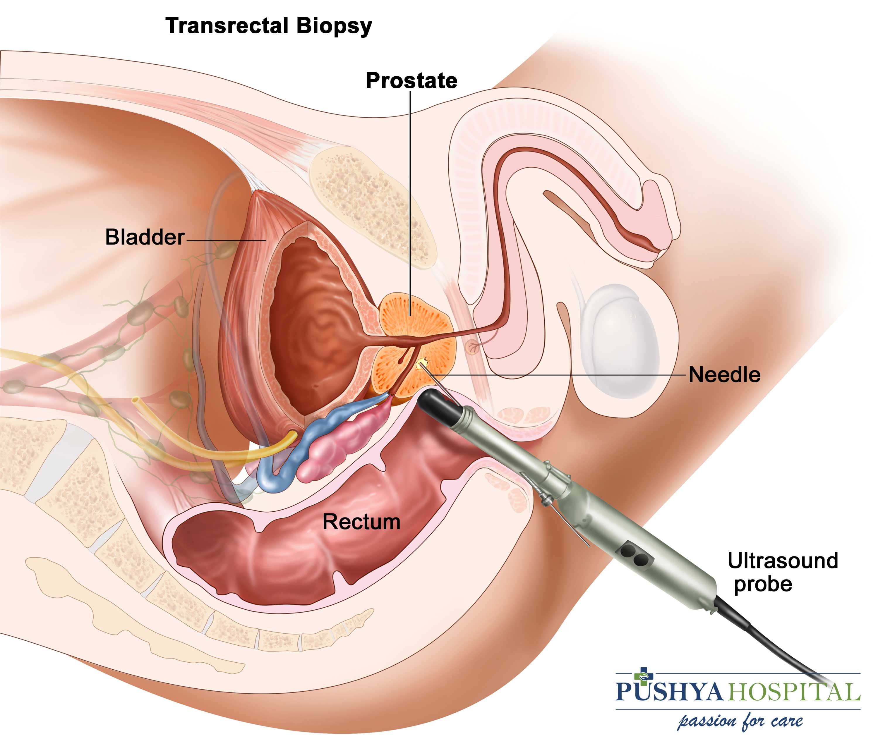 how to drain prostate gland