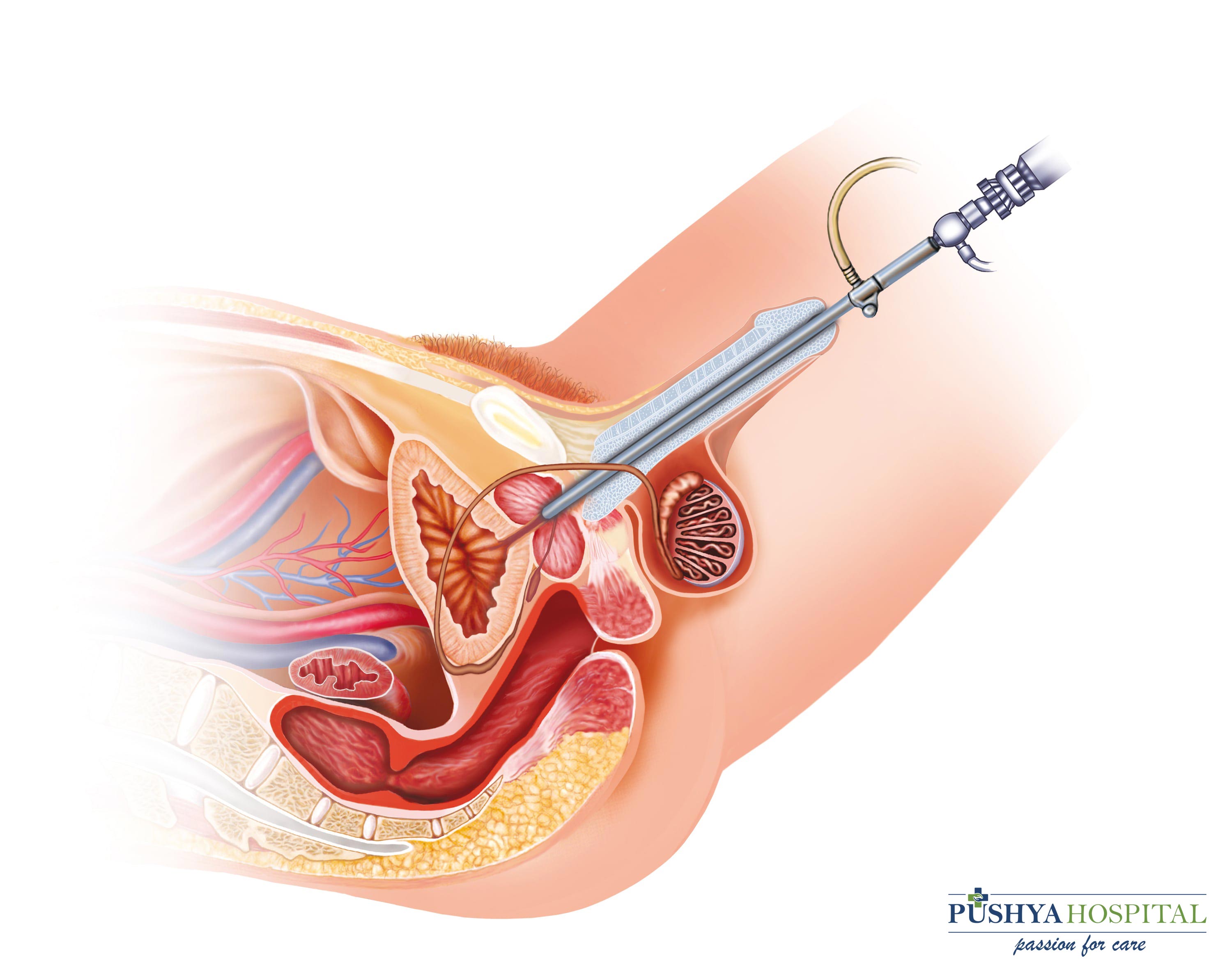 Chirurgia uretrală